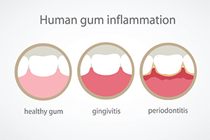 Human Gum Inflamation